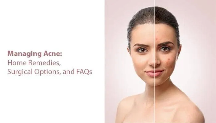 Managing Acne: Home Remedies, Surgical Options, and FAQs