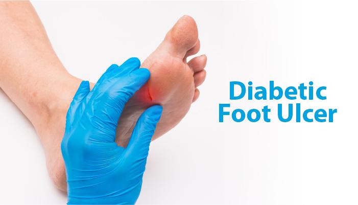 Diabetic Foot Ulcer Treatment in Hyderabad | by KBK Hospitals | Medium