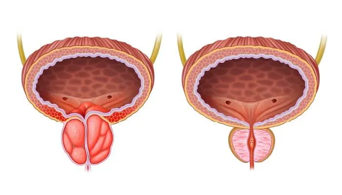 Prostate Enlargement