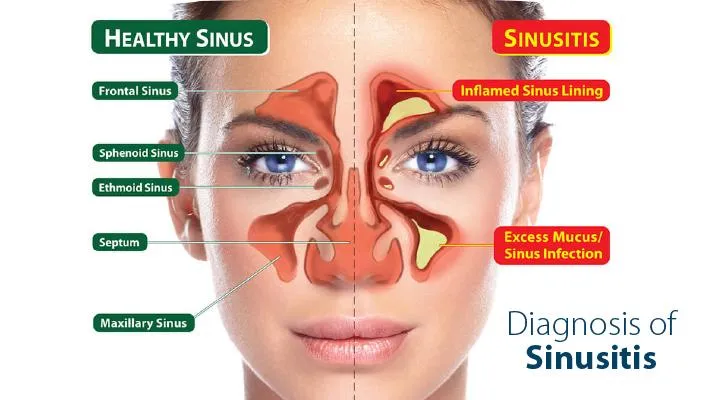 Sinus Treatment