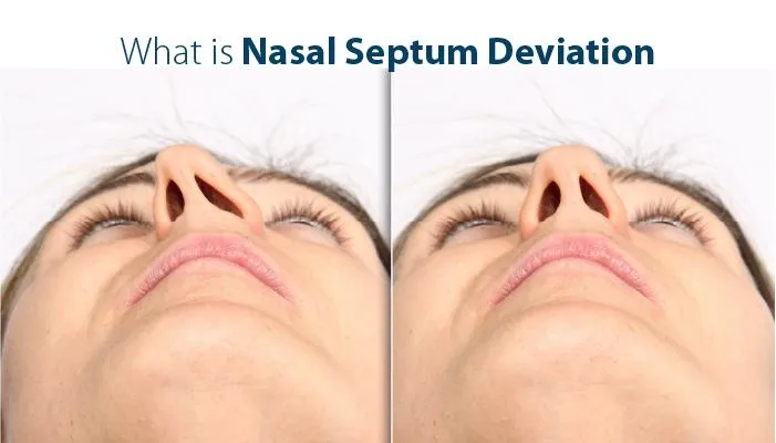 Nasal Septum Deviation