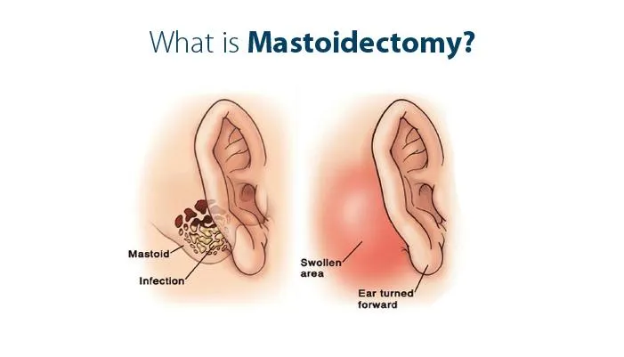 Mastoidectomy