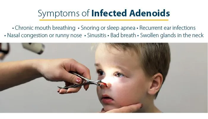 Adenoidectomy