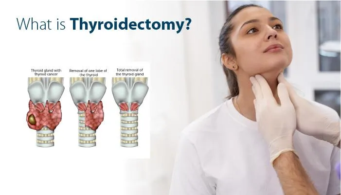 Thyroidectomy Surgery