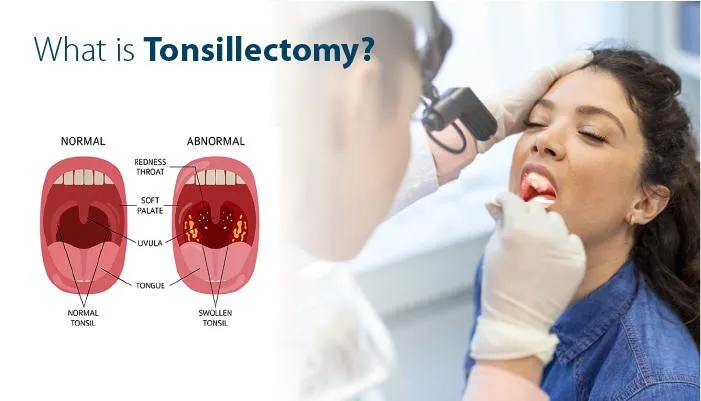 Tonsillectomy