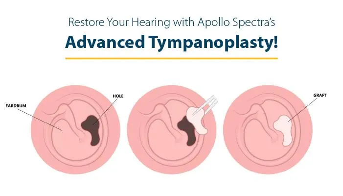 Tympanoplasty