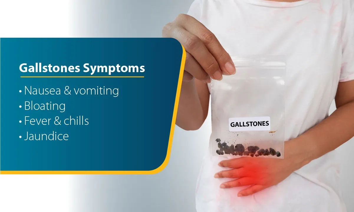 Gallstones: Causes, Symptoms, Diagnosis, and Treatment