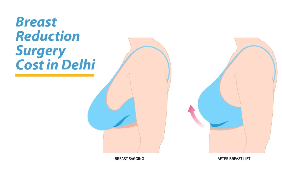 Breast Reduction Surgery Cost in Delhi