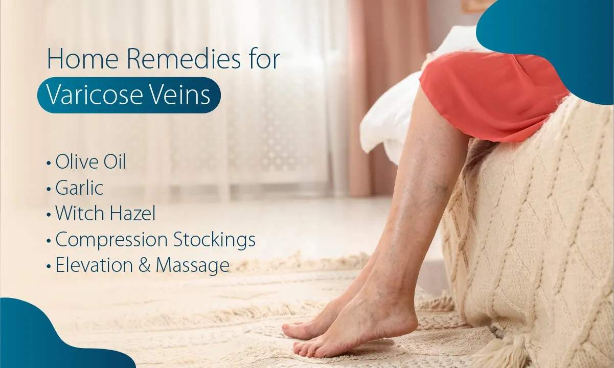 Home Remedies for Varicose Veins