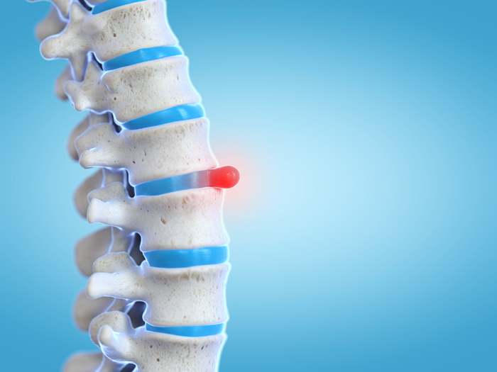 Herniated Disc - Apollo Physical Therapy Centres