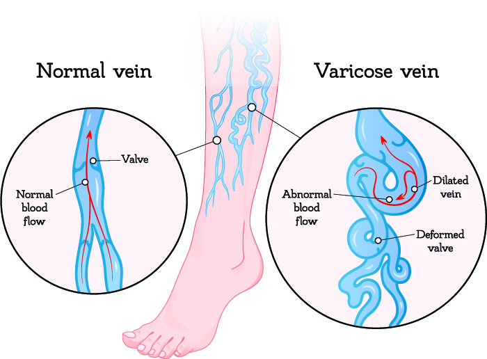 Varicose vein Stocking at best price in Pune by Care Orthotics